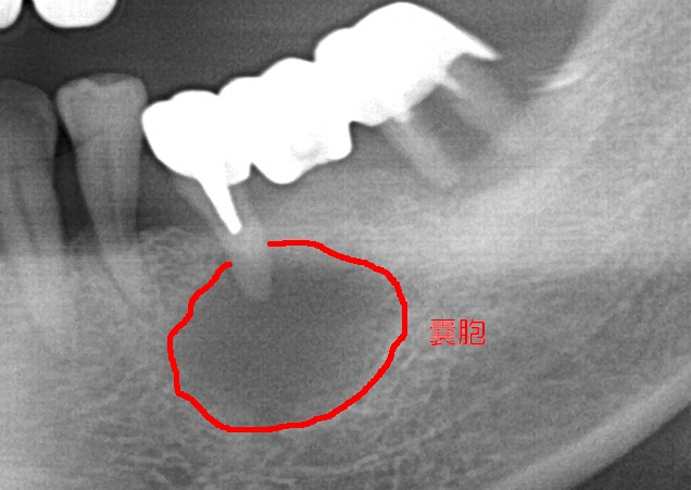 大きな歯根嚢胞 フリージア歯科クリニックオリックス本町ビル院